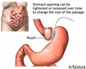Adjustable gastric banding