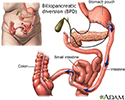 Biliopancreatic diversion (BPD)