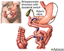 Biliopancreatic diversion with duodenal switch