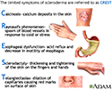 CREST syndrome