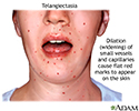 Telangiectasia