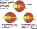 Normal, nearsightedness, and farsightedness