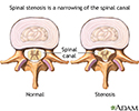 Spinal stenosis