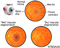 Macular degeneration