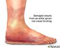 Ankle sprain swelling