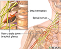 Neck pain