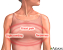 Breast pain
