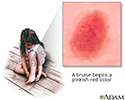 Bruise healing - series