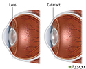 Cataract