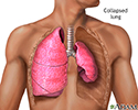 Collapsed lung, pneumothorax