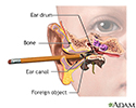 Foreign object in ear