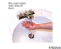 Minor burn treatment - run under cool water