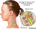 Spinal cord injury