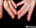Amyloidosis of the fingers