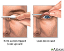 Eyelid eversion