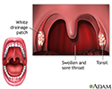 Strep throat