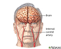 Stroke - Series