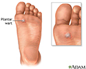 Plantar wart