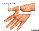 Subungual wart