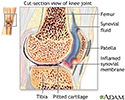 Rheumatoid arthritis