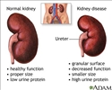Diabetic nephropathy