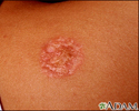 Necrobiosis lipoidica diabeticorum - abdomen