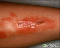 Necrobiosis lipoidica diabeticorum - leg