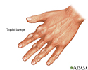 Tophi gout in hand