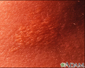 Xanthoma - close-up