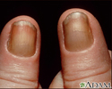 Yellow nail syndrome