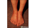 Atopy on the ankles