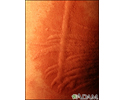 Dermatographism - close-up