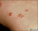 Chigger bite - close-up of blisters