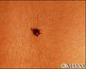 Tick imbedded in the skin