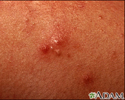 Acne - close-up of pustular lesions