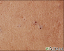 Blackheads (comedones)