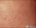 Blackheads (comedones) close-up