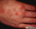 Angioma serpiginosum