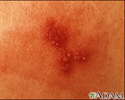 Herpes simplex - close-up