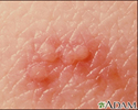 Herpes zoster (shingles) - close-up of lesion