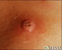 Wart (close-up)