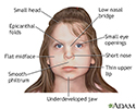 Fetal alcohol syndrome