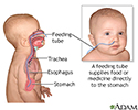 Feeding tube