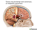 Brain tumor