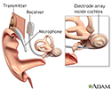 Cochlear implant