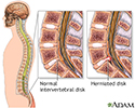 Microdiskectomy - series