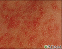 Erythema toxicum neonatorum - close-up
