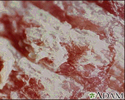 Psoriasis - magnified x4