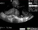 Ultrasound, normal placenta - Braxton Hicks