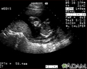 Ultrasound, normal fetus - face